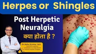 NERVE PAIN AFTER SKIN RASH? | Post Herpetic Neuralgia | Herpes or Shingles क्या होता है ?