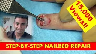 Expert Guide: Step-by-Step Surgical Nailbed Repair by a Consultant Plastic and Hand Surgeon