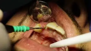 Patient Mina Testimonial - All On X Dental Studio