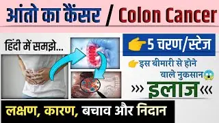 आंतों का कैंसर के लक्षण, कारण और इलाज || colon cancer ke lakshan || colon cancer ka ilaj || Cancer😱