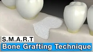 Bone Grafting | Minimally-Invasive S.M.A.R.T. Bone Graft