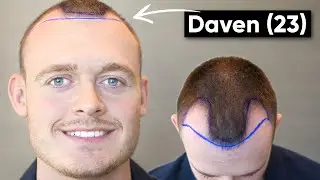 Geheimratsecken mit 23 Jahren | Davens Haartransplantation im Memorial