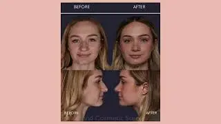 A Nose Job in LESS than 30 minutes | Non-Surgical Rhinoplasty with Dr. Jacob Haiavy