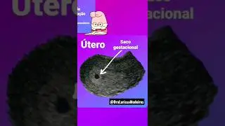 Com quantas semanas de gestação aparece o saco gestacional no ultrassom?