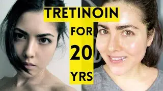 20 Year Results of Using Tretinoin