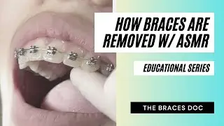 How Braces Are Removed | Braces Removal Video w/ ASMR | The Braces Doc