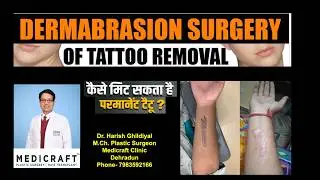 Tattoo Removal I Permanent Surgical Tattoo Removal I टैटू को हटाने की सर्जरी