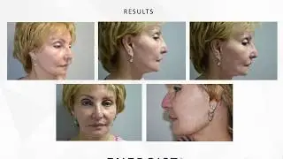 NeoGen Results