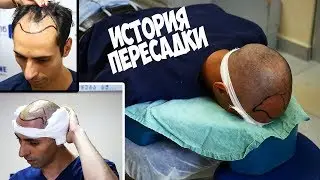 ПЕРЕСАДКА ВОЛОС В ТБИЛИСИ. Hearline | КАК ВСЕ ЭТО БЫЛО, СМОТРИ ДО КОНЦА