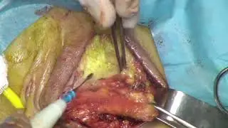 Rectovaginal fistula post low anterior tumor resection: Modified Martius graft technique