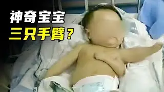 男童身患怪病，三条手臂一个肾，如何切除成大难题