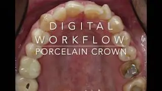 Dental Crown Digital Workflow