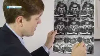Dr. Casal: ciática-hernia discal.