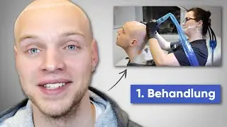 Er musste Minoxidil absetzen... Jetzt macht er eine Haarpigmentierung | Erfahrung