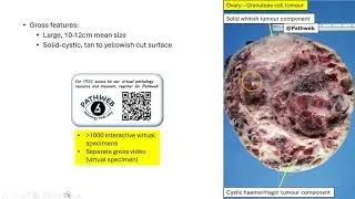 Ovary: Granulosa cell tumour, adult type - Virtual microscopy