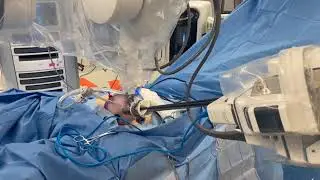 Single Port Robotic Right Hemicolectomy with Intracorporeal Anastomosis