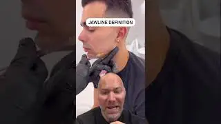 Men Can Create a Jawline With Filler?! 😱 