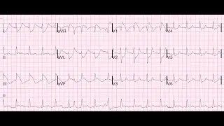 The EDUCATE Trial | EKG Education - See Description Below