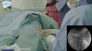 Flouroscopic guided puncture