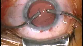 Intraoperative Aberrometry, I-O-W-A  meets trifocal IOL Zeiss  AT LISA 839