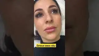 Коррекция губ филлером на основе гиалуроновой кислоты 