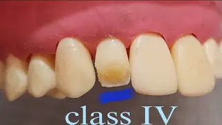 حشو الكمبوزيت خطوه ب خطوه/ Composite restoration class IV step by step