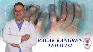 Bacak Kangren Tedavisi