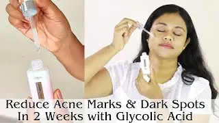Reduce Acne Marks & Darks Spots In 2 Weeks | Loreal Glycolic Dkin Brightening Serum Review