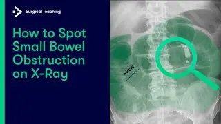 How to Spot Small Bowel Obstruction on X-Ray