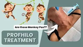 Profhilo Treatment