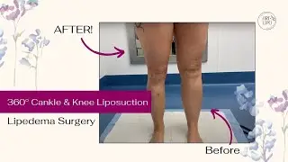 LIPEDEMA LIPOSUCTION | 360° CANKLE & KNEE LIPOSUCTION | Artlipo | Expert Dr. Thomas Su