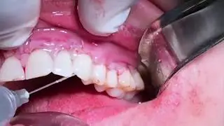 soft tissue graft