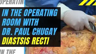 Tummy Tuck (Abdominoplasty) - Repair of Severe 