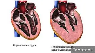 Кардиомиопатия  Как лечить кардиомиопатию