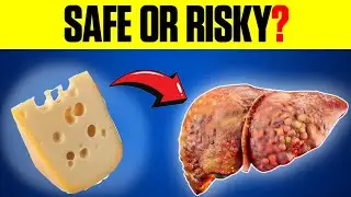 Is Cheese Bad For Fatty Liver ? Cheese vs Fatty Liver Diet
