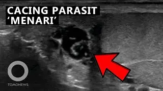 Cacing Parasit Ditemukan ‘Menari’ di dalam Kantung Testis