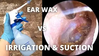 Water Irrigation And Suction Used To Clear Ear Wax