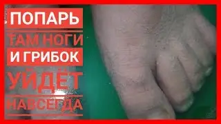 How to Quickly and Effectively Cure FOOT and Hand FUNGUS. NAIL FUNGUS GONE. Instant Results!