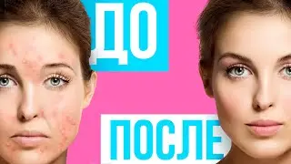УХОД ЗА КОЖЕЙ ЛИЦА: 16 СПОСОБОВ КАК ПРЕДОТВРАТИТЬ ПОЯВЛЕНИЕ ПРЫЩЕЙ