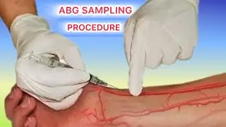 Arterial Blood Gas (ABG) Simple Procedure and Technique - Stepwise Approach