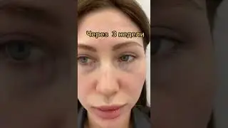 Верхняя блефаропластика. До/после.