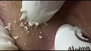 Remove sebaceous filaments on the nose 