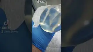 Breast Implant Replacement Surgery in San José, Costa Rica.