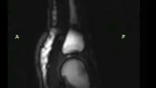 MRI movie peers inside cracking knuckles