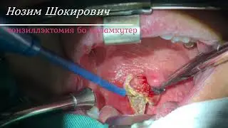Нозим Шокирович. Удаление миндалин методом электрокоагуляции. тозиллэктомия бо электрокоагулятор.