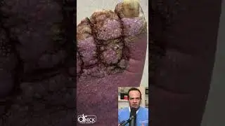 UNREAL CHANGES TO FEET FROM SEVERE LEG SWELLING!😱 