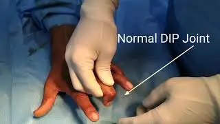 All inside Mallet finger repair