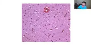 NEUROPATHOLOGY: BOARD REVIEW 1