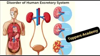 Disorders of Excretory system chronic kidney disease #urinary_system #kidneydisease #toppersacademy