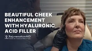Discover the Magic of Long-Lasting Voluma Cheek Filler